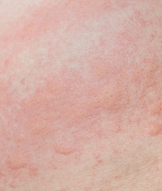 allergic-skin-rash-prickly-heat-skin-red-dot-close-2048
